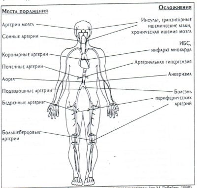 Рис. 1 Сердечно-сосудистые заболевания, вызываемые атеросклерозом (по М.Дебейки, 1998)